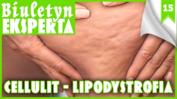 Cellulit - Lipodystrofia - Biuletyn Eksperta, nr 15